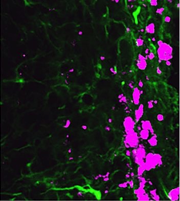 Reprogrammed stem cells (green) hunt and kill glioblastoma cells (pink)